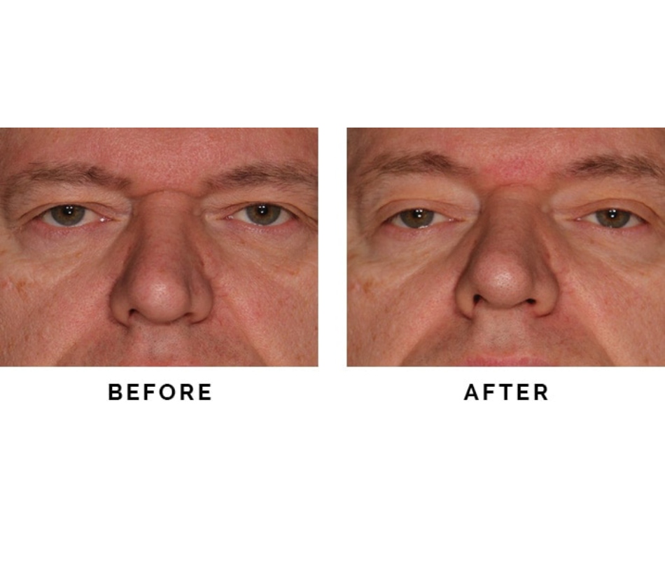 Sofwave-before-and-afters man eyes