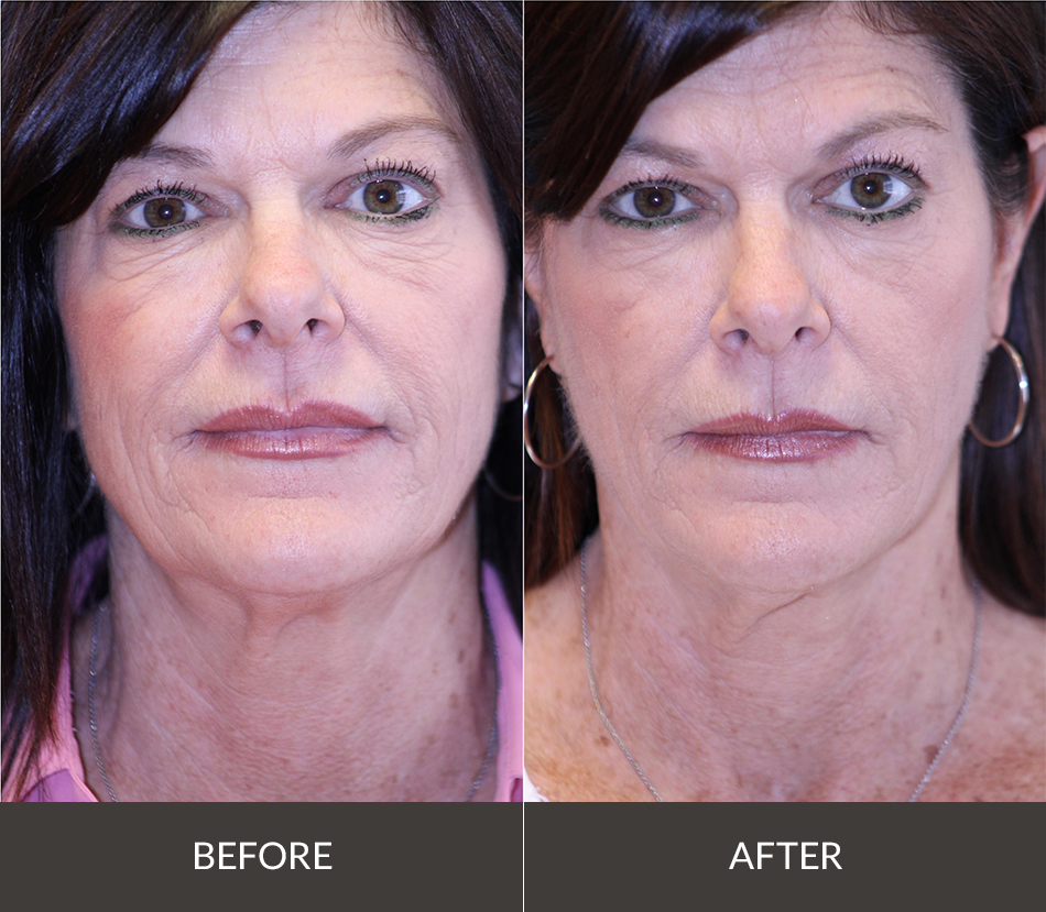 sofwave before and after face and neck2
