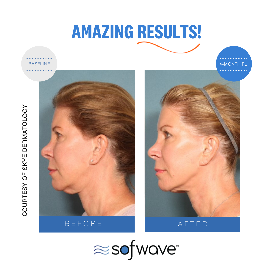 sofwave before and after side profile