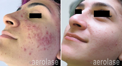 Acne Before & after Treatment result in Marietta, GA by Misty Med Spa & Skin Rx