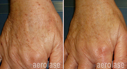 Pigmented Spots Before & after treatment result in Marietta, GA by Misty Med Spa & Skin Rx