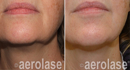 Rejuvenation Before & after treatment result in Marietta, GA by Misty Med Spa & Skin Rx