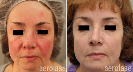 Rosacea Before & after treatment result in Marietta, GA by Misty Med Spa & Skin Rx