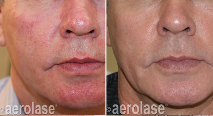 Skin Rejuvenation Before & after treatment result in Marietta, GA by Misty Med Spa & Skin Rx